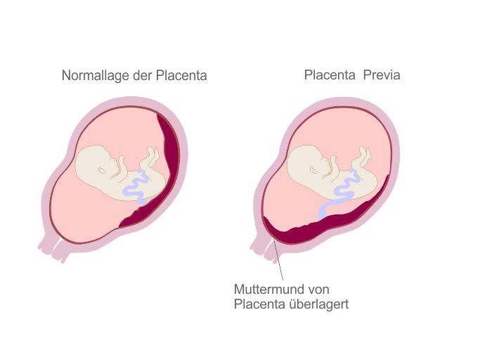 Placenta praevia