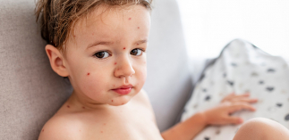 Kinderkrankheiten mit Hautausschlag